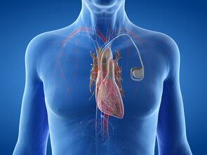 Implantation eines Herzschrittmachers